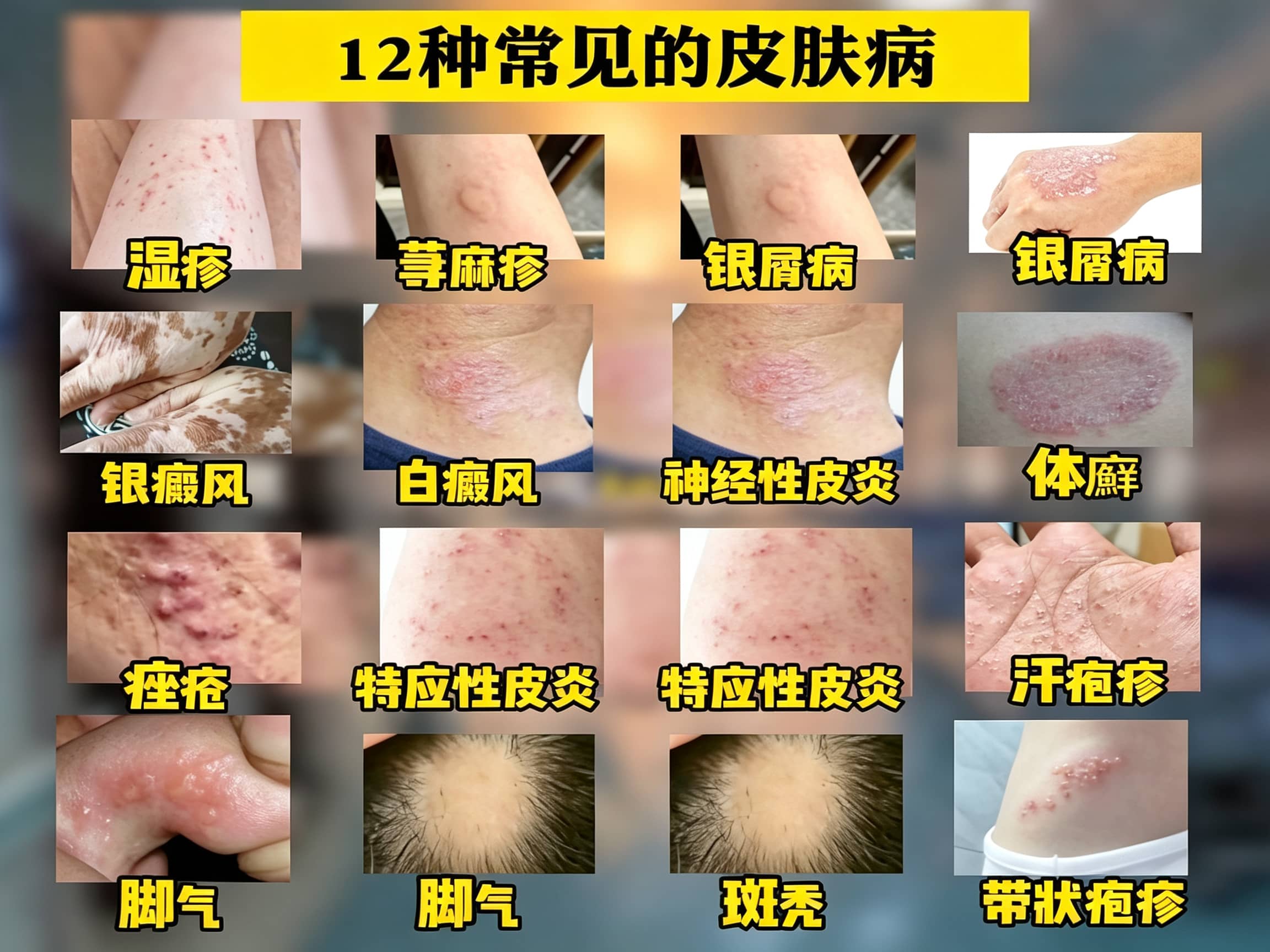 常见皮肤病介绍（湿疹、痤疮、色素痣、斑秃、荨麻疹）