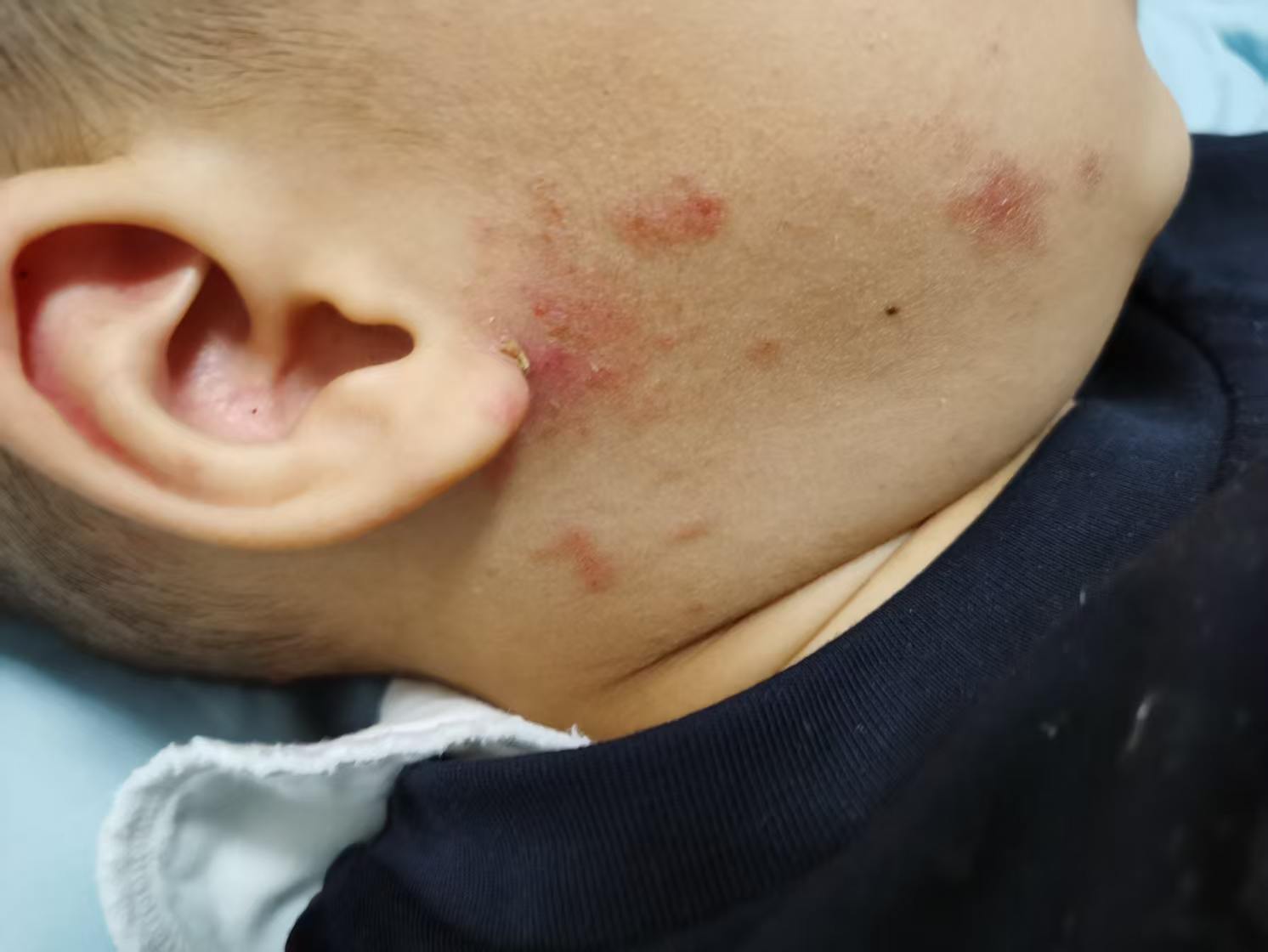王 XX小朋友全身泡疹